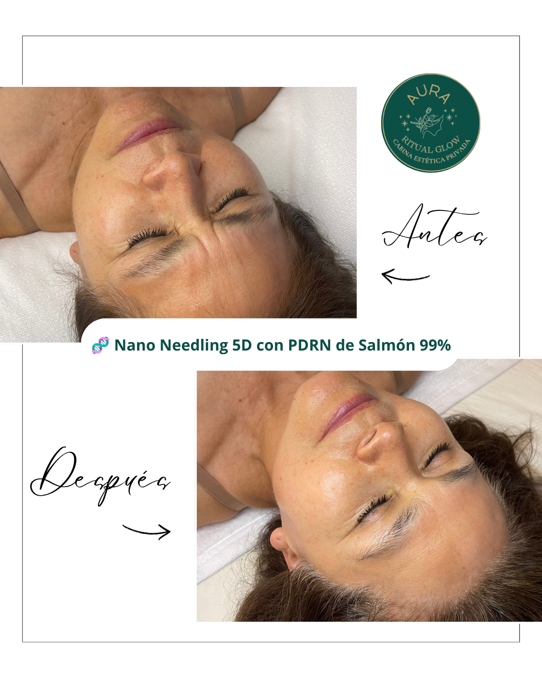 Antes y después dermapen