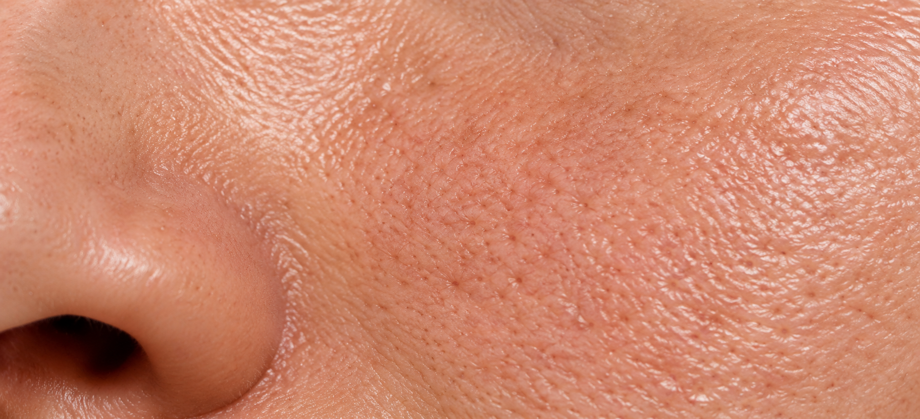 Dermapen Control Grasa y Poros