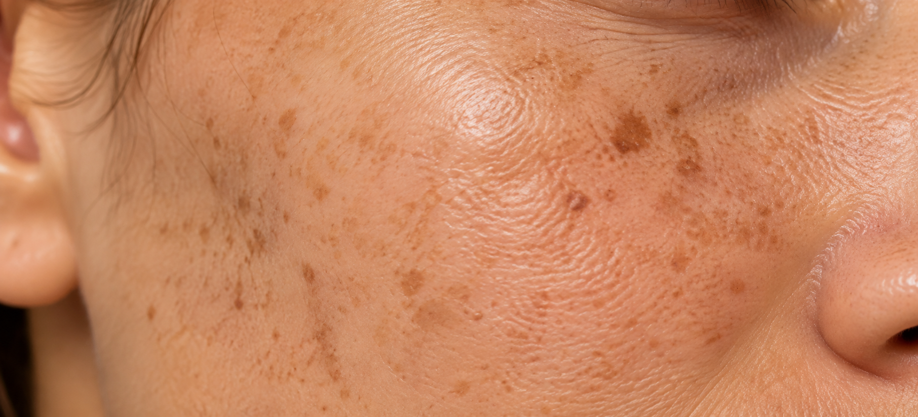 Dermapen Manchas y Tono Uniforme​